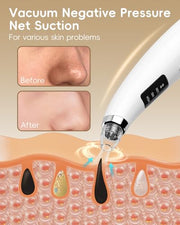 Blackhead Remover Pore Vacuum with 3 Suction Levels 5 Probes