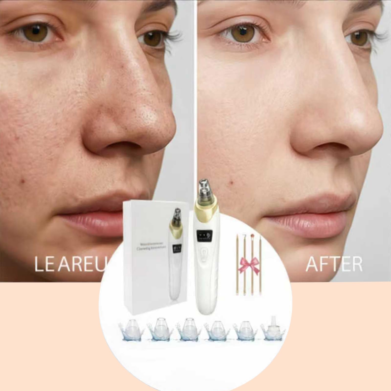 Electric Blackhead Remover 5 Suction Heads 8 Gold Needles USB Rechargeable