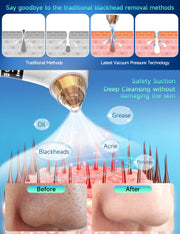 Visible Blackhead Remover Pore Vacuum 6MP Camera 5 Suction Levels